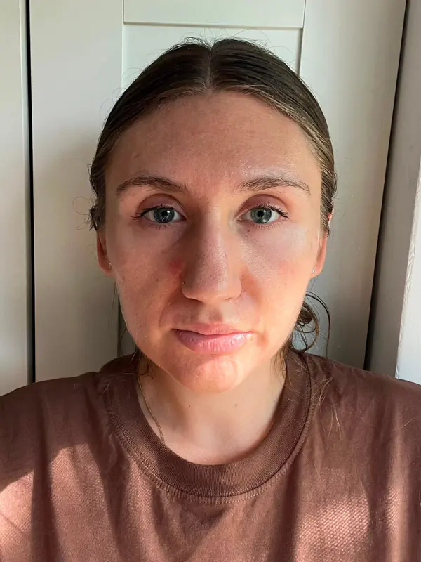 Teilnehmerin vorher, Gesicht von vorn